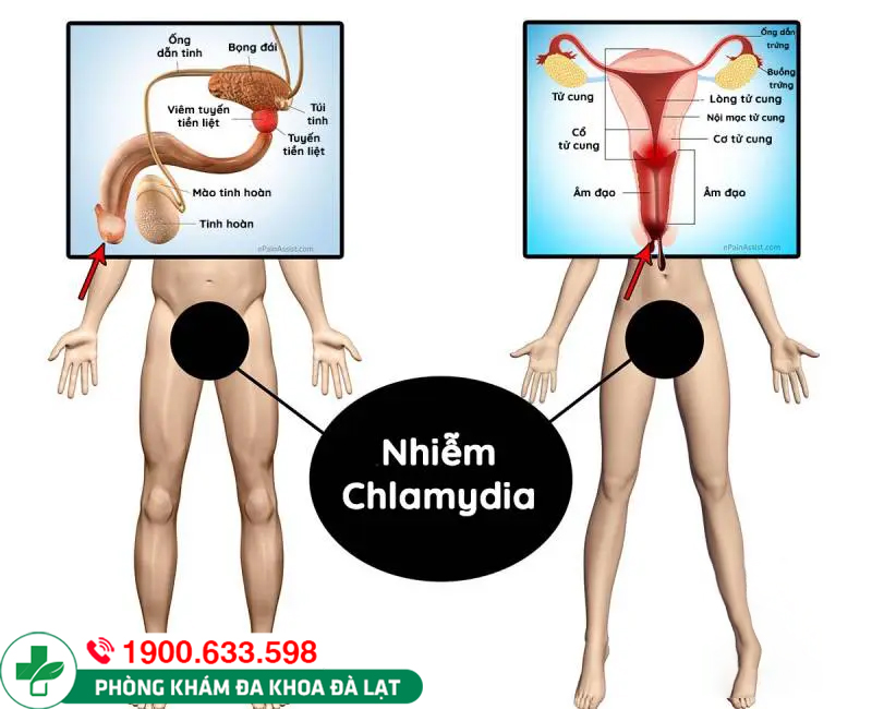 Tổng quan bệnh chlamydia ở nam & nữ giới